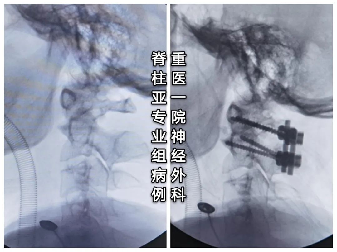 C2椎动脉高跨置钉技术之N