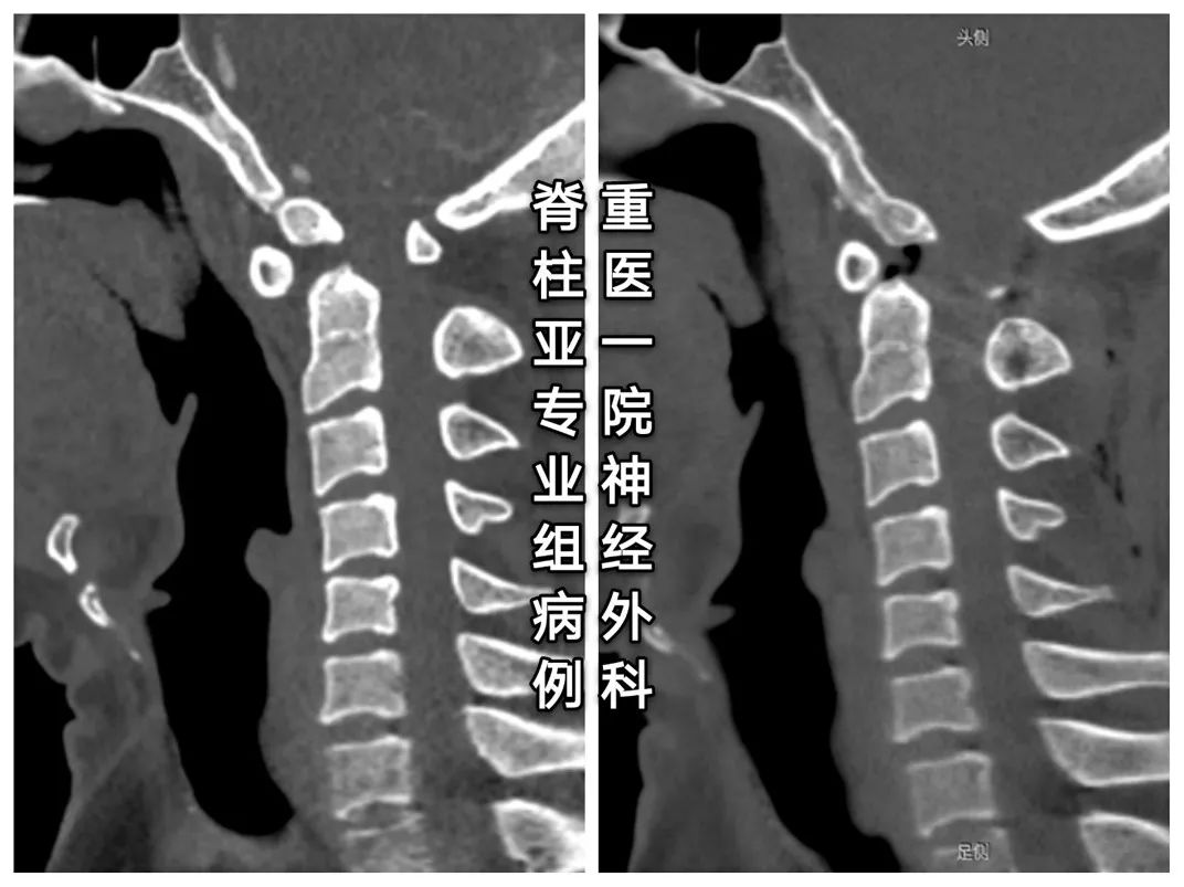 C2椎动脉高跨置钉技术之N