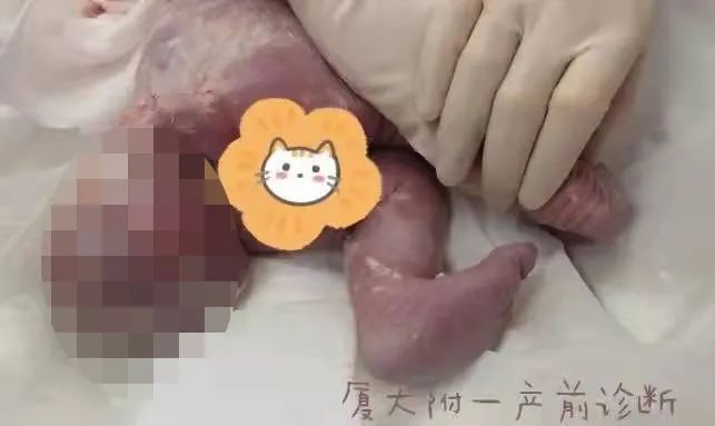 崩溃！女子怀孕5个月，发现胎儿竟有“尾巴”…