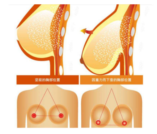 乳房下垂怎么手术(「济南韩氏郭广科」乳房下垂的矫正与治疗)