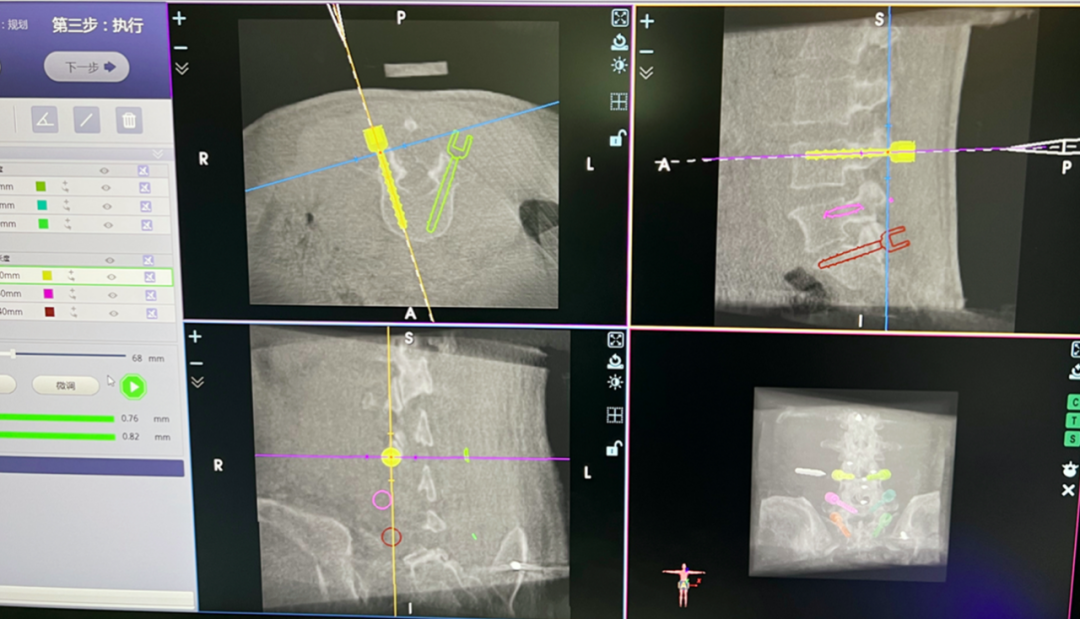 男子腰椎打进6颗钢钉！手术机器人“帮了大忙”！
