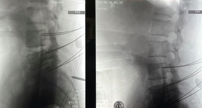 男子腰椎打进6颗钢钉！手术机器人“帮了大忙”！