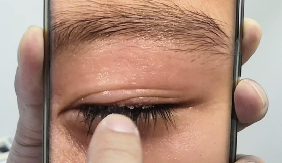 502礁水能粘乒乓球拍嗎（8歲男孩眼睛濺入502膠水，媽媽一番操作粘得更緊了）