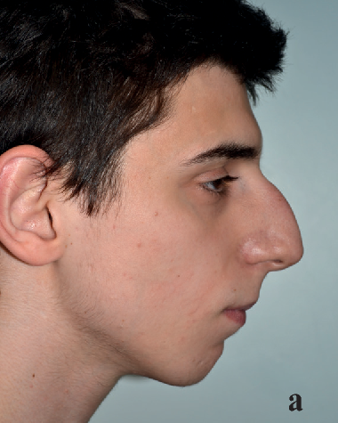 鞍鼻-鞍鼻就是从山根到鼻梁不同程度凹陷,只有鼻尖上翘有一定高度