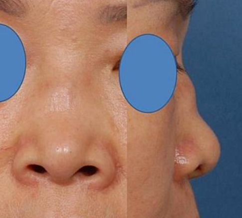 问题鼻型盘点,看看有没有你的同款?