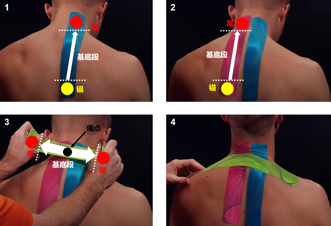 肌内效贴布肩膀贴法图（健身战疫系列-科学利用肌内效贴缓解战“疫”辛劳（二））