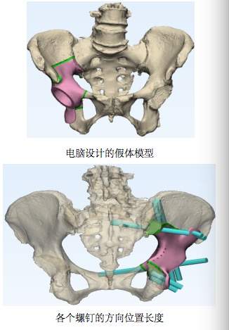 骨盆也能“量身定制”，65岁阿姨装上了3D打印的半个骨盆