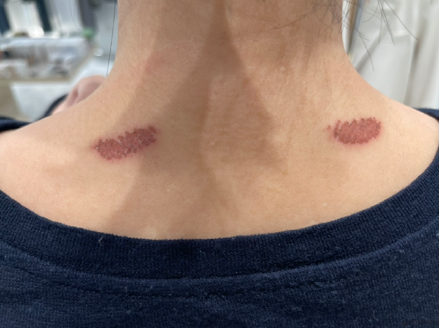 起底“假洋貨”SKG：毛利率遠超蘋果，常年打醫療器械擦邊球