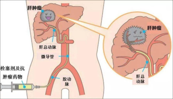 介入治疗那些事儿，您get了吗？