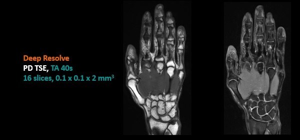 西门子医疗利用人工智能加速磁共振扫描时间、提高成像质量