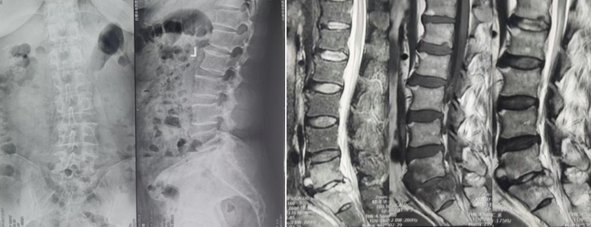 【医疗动态】脊柱骨二科完成医院首例腰骶椎结核患者骶2（S2AI）螺钉腰骶髂固定融合术