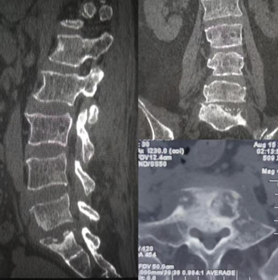 【医疗动态】脊柱骨二科完成医院首例腰骶椎结核患者骶2（S2AI）螺钉腰骶髂固定融合术