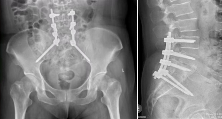 【医疗动态】脊柱骨二科完成医院首例腰骶椎结核患者骶2（S2AI）螺钉腰骶髂固定融合术