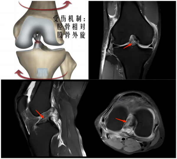 足球什么位置愛受傷（健康科普｜足球場上常見的運動損傷，你了解嗎？）