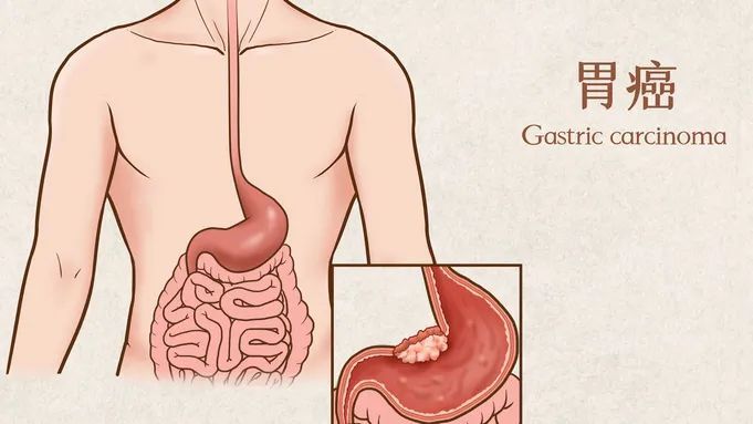 肚子疼一陣一陣的絞痛怎麼回事 為啥肚子疼一陣一陣的-大財經