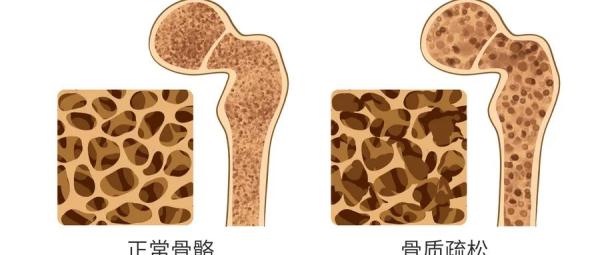 台州女子突然变矮5厘米!原因跟这个习惯有关,很多人都有!