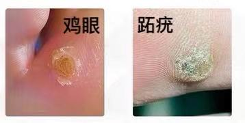 脚上的硬疙瘩是老茧?当心**眼,甚至是病毒感染!3招助你消疙瘩,护好双脚~