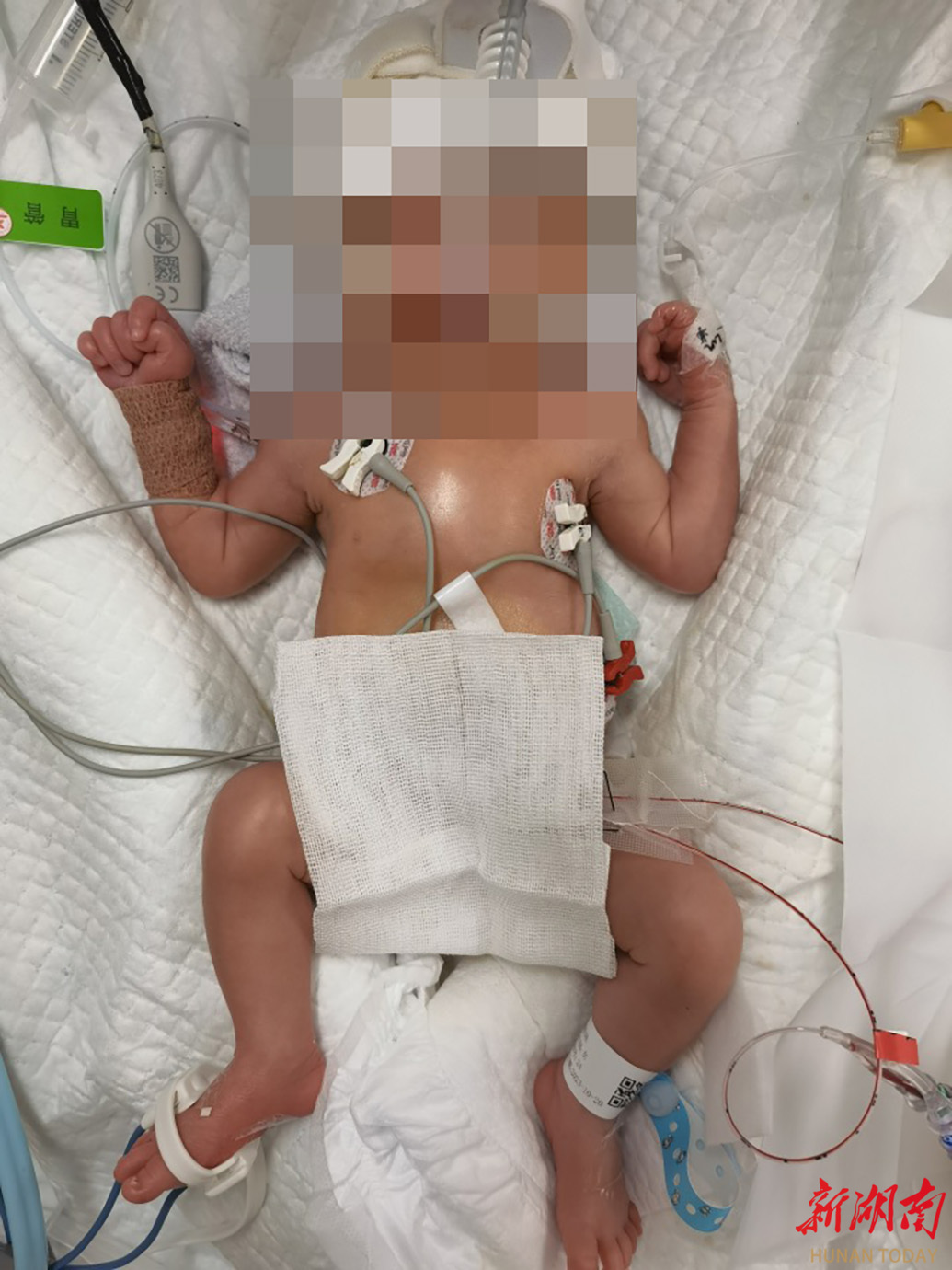 4次胎儿宫内输血,守护她的母亲梦