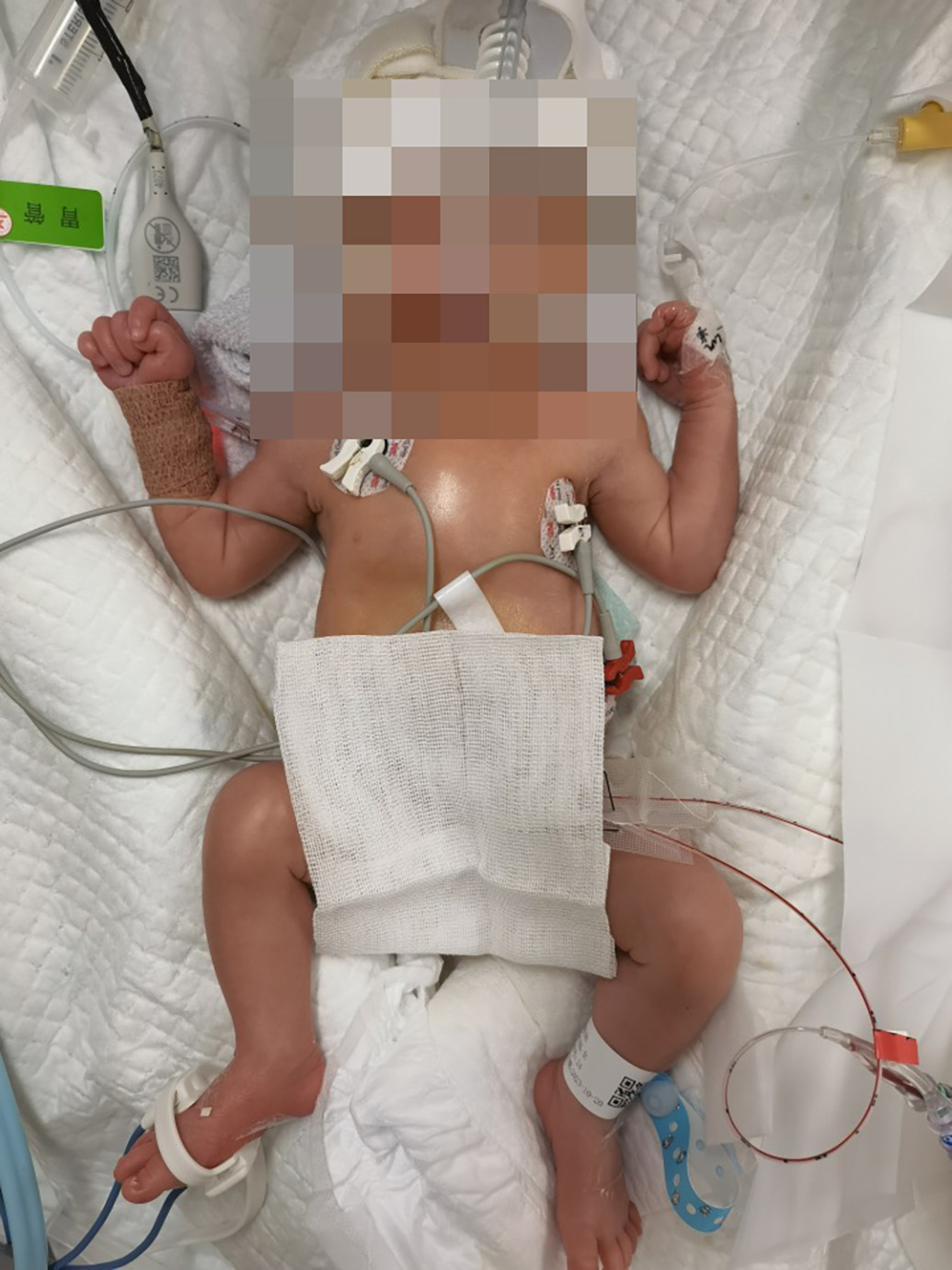 母胎血型不合三次胎死腹中,一孕妇经四次宫内输血后平安产子