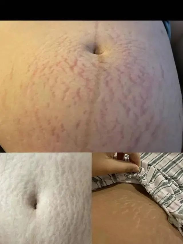 一张产床的抓痕照,引20万妈妈共鸣
