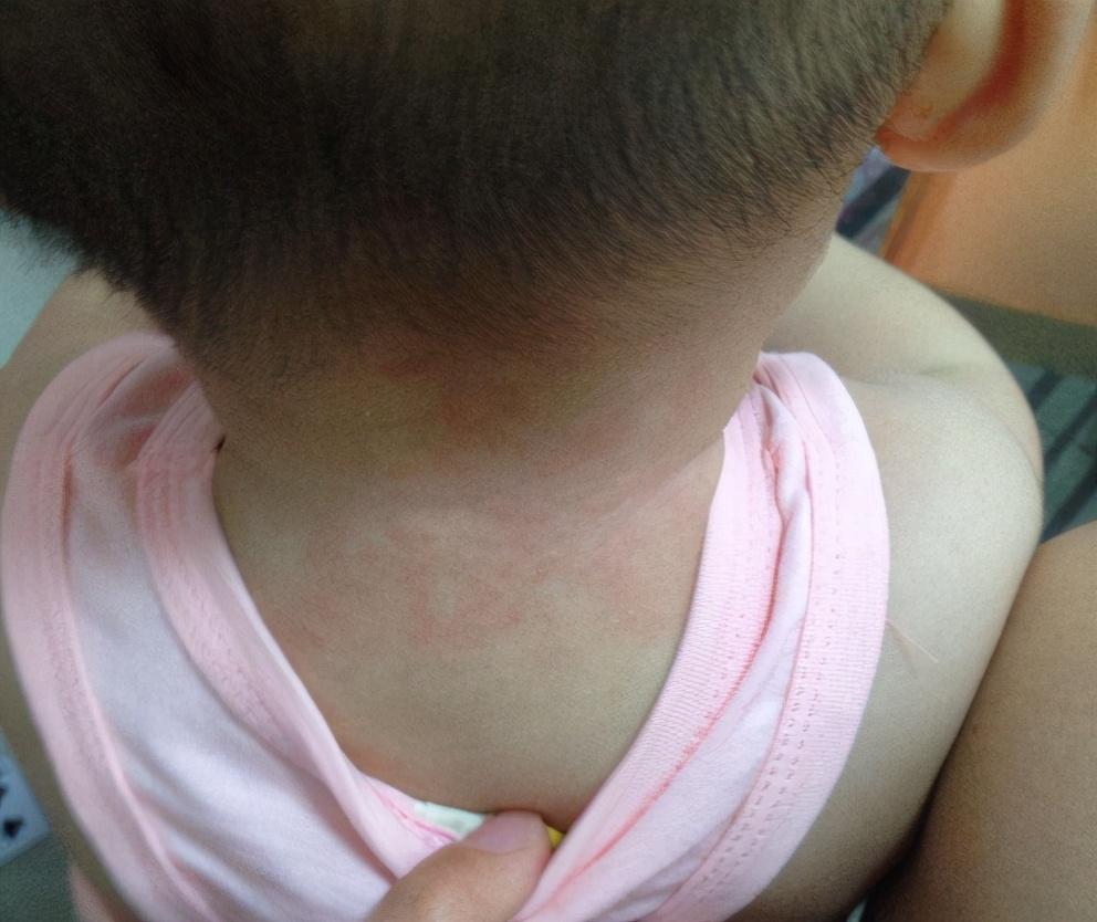 小孩长痱子怎么办(为啥天热宝宝爱长痱子) - 乐宝宝贝