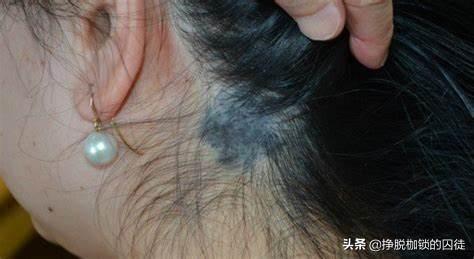 皮肤表面黑色素斑图片，皮肤各种斑的图片介绍（为什么小孩的屁股上的青斑叫蒙古斑）