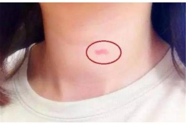 怎么快速消除草莓印，草莓印怎么快速消除（怎样快速消除草莓印）