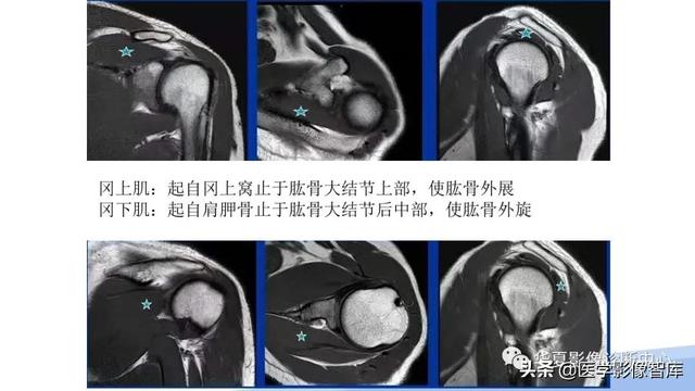 肩关节骨标志解剖图，全面掌握肩关节解剖