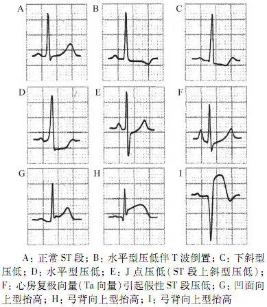 qtc间期正常值，心电图qt和qtc间期正常是多少毫秒