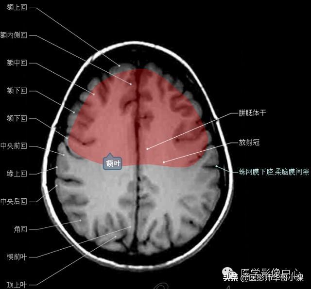 颅脑mri(头部MRI)插图(27)