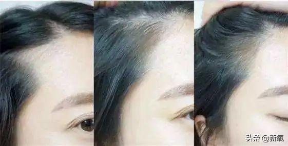 发际线粉会堵塞毛孔吗，发际线粉的危害（关晓彤才23岁就秃了）