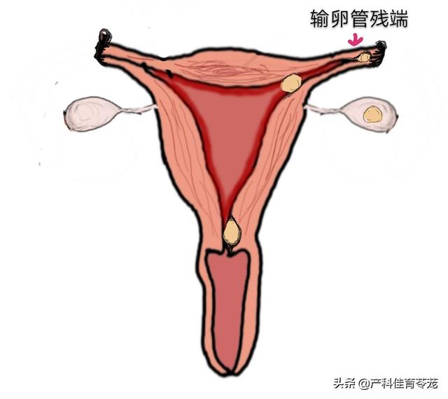 宫外孕必须手术吗，宫外孕一定要手术吗（宫外孕之你问我答）