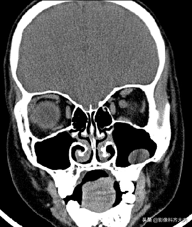 鼻窦炎的ct图片大全图片