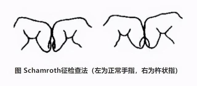 怎么判断是不是杵状指图片，怎样辨别是不是杵状指（身体给的提醒）