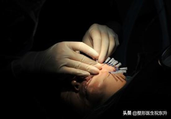 什么是面部线雕，什么是面部线雕（医生告诉您6个\