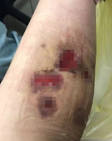 溶脂针瘦腿有什么危害，溶脂针瘦腿有什么危害吗（28岁女子打“瘦腿针”后险遭截肢）