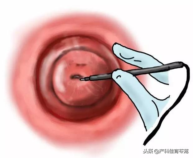 1,做宫颈细胞学检查排除宫颈病变或者宫颈癌:关于宫颈细胞学检查,这里