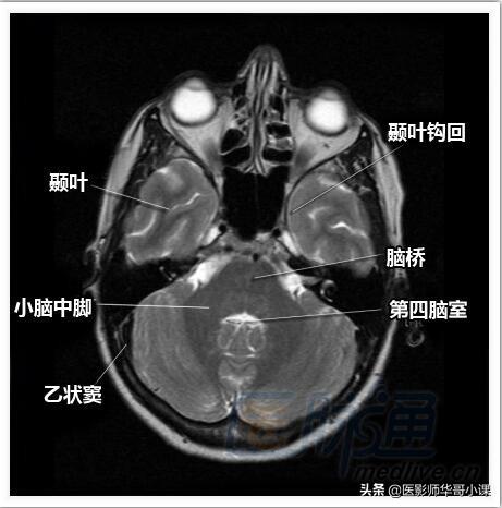 颅脑mri(头部MRI)插图(2)