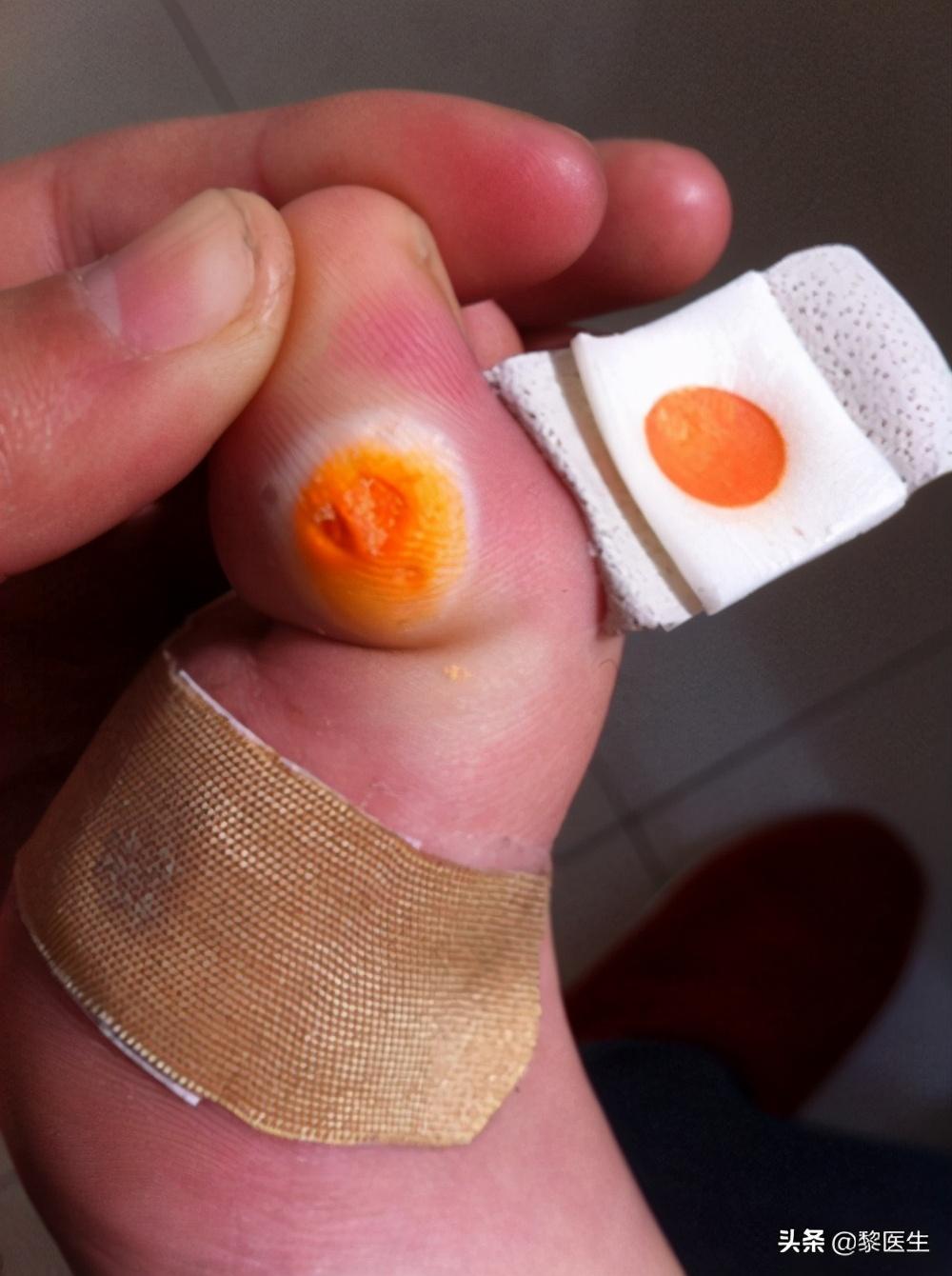 鸡眼刚开始的样子图片,手指,脚趾上的鸡眼用刀削去