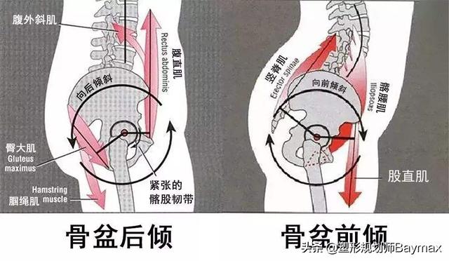 骨盆前倾的危害，骨盆前倾的危害和表现（产后腰痛千万不要做这个动作）