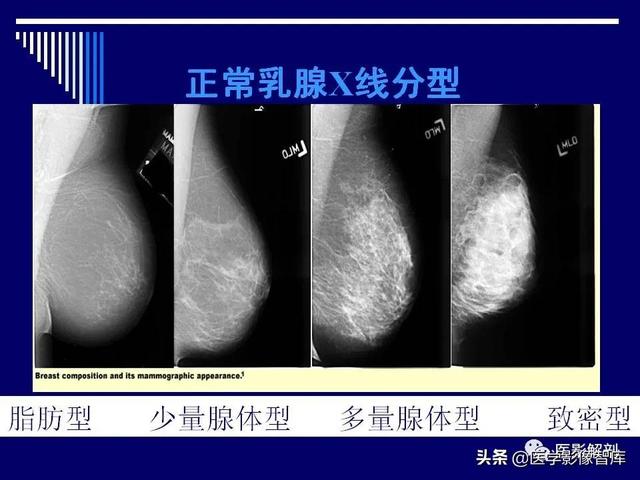 乳房解剖学基础知识，乳腺解剖及乳腺各病变影像诊断与鉴别