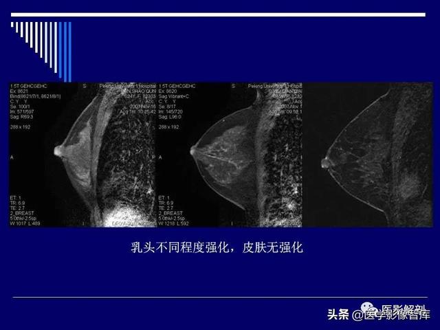 乳房解剖学基础知识，乳腺解剖及乳腺各病变影像诊断与鉴别