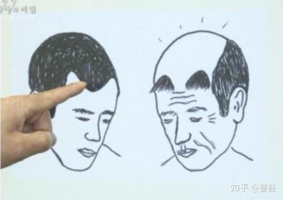 植发是永久的吗，植发是不是永久的（植发的效果能维持一辈子吗）