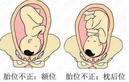 右边胎动多是男孩还是女孩，胎动在右边女孩（胎动在左是男孩）
