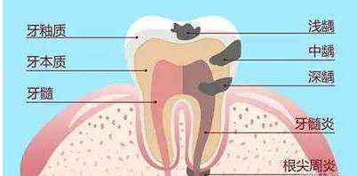 龋齿是什么样子的图片(龋齿是什么牙齿)插图(7)