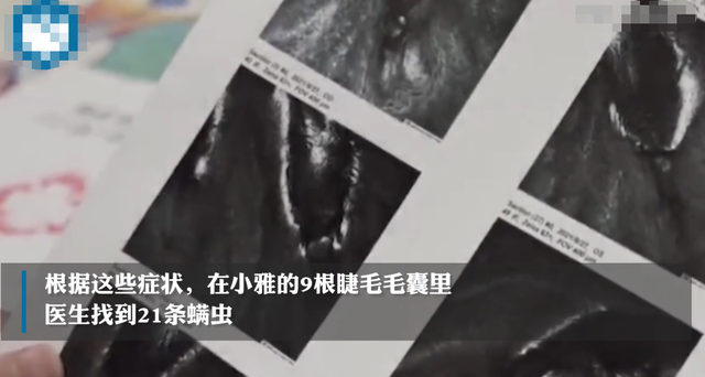 床上螨虫咬的症状图片，如何判断被褥有没有螨虫以及如何预防（医生从9根睫毛找到21条螨虫）