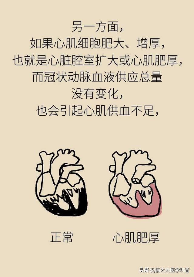 心肌缺血的原因，心脏缺血怎么办怎么补（心肌为什么会缺血）
