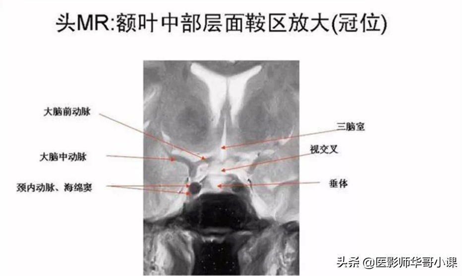 颅脑mri(头部MRI)插图(61)