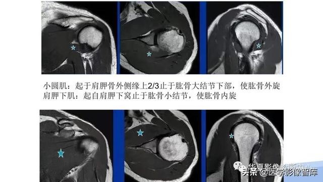 肩关节骨标志解剖图，全面掌握肩关节解剖