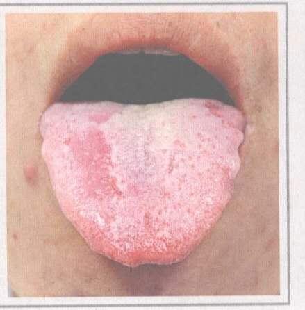 舌淡苔白滑的症状及预示的疾病类型,舌淡苔白滑是什么意思(怎样通过